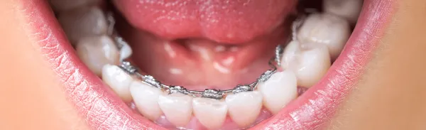 lingual-braces-almancil-faro-algarve-01