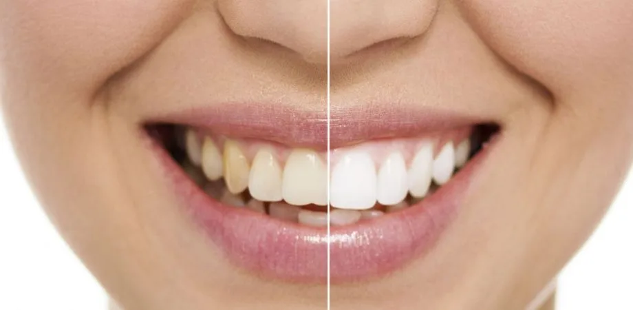 Resultado de branqueamento dentário "antes e depois" realizado na clínica Atelier do Sorriso Almancil, Faro, Algarve