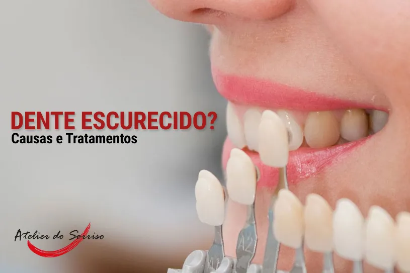 causa-dentes-escurecidos