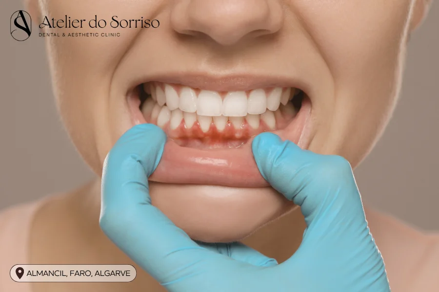tratar-gengivite-periodontite-algarve-faro-almancil-02
