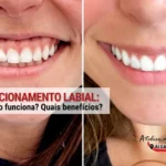 antes-depois-reposicionamento-labial-algarve