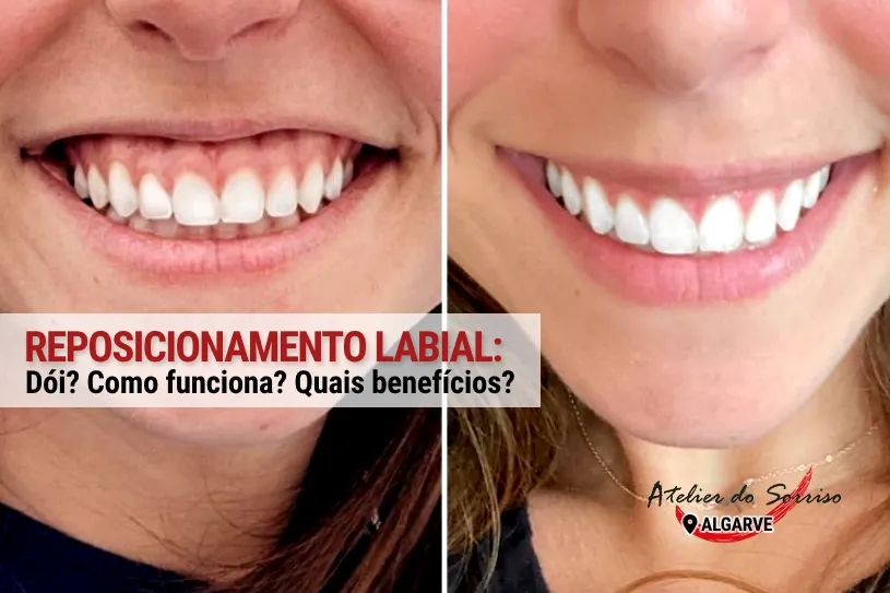 antes depois reposicionamento labial algarve