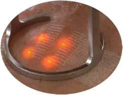 fractional-erbium-laser-portugal-algarve-01