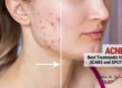 best-treatments-acne-scars-faro-algarve-portugal
