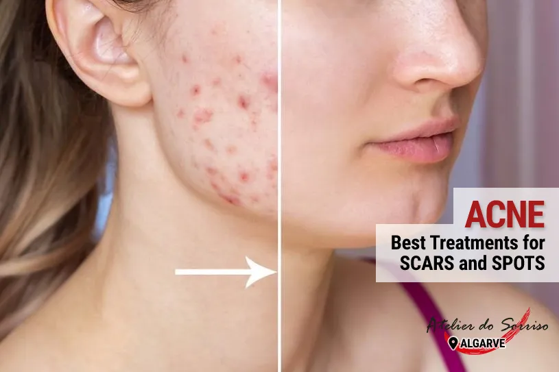 best-treatments-acne-scars-faro-algarve-portugal best-treatments-acne-scars-faro-algarve-portugal