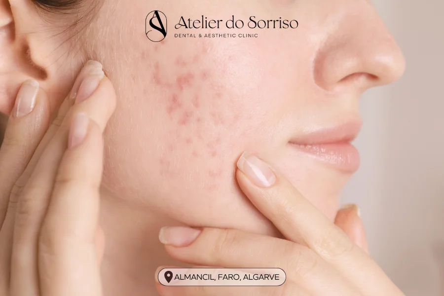 tratamentos cicatrizes acne algarve faro almancil