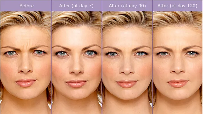 caso-aplicacao-botox-algarve-01