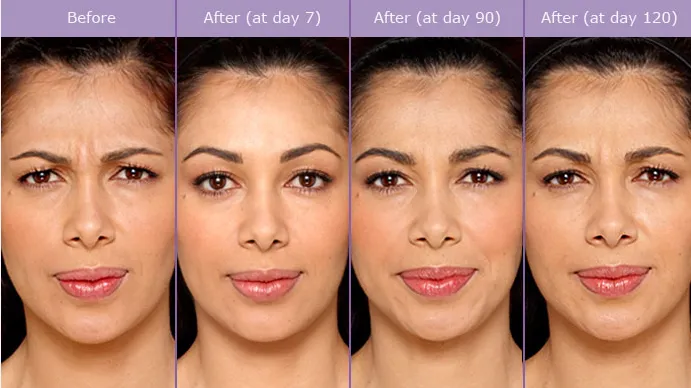 caso-aplicacao-botox-almancil-01