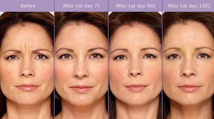 caso-aplicacao-botox-faro-01