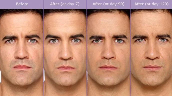 caso-aplicacao-botox-homem-quarteira-01
