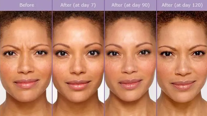 caso-aplicacao-botox-vilamoura-01