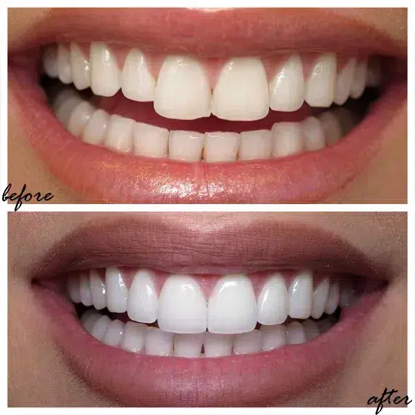 facetas dentarias antes depois faro algarve almancil