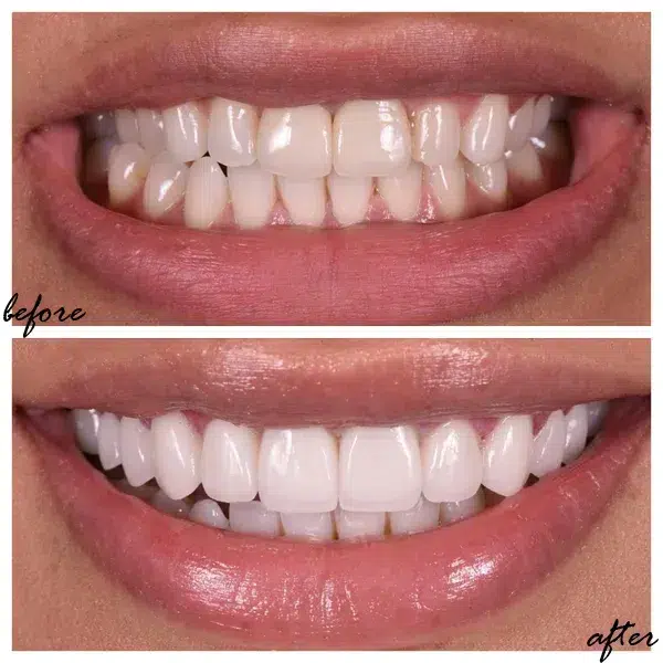 facetas dentarias antes depois faro almancil