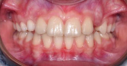 patient invisalign after[]