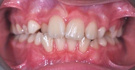 patient invisalign before[]