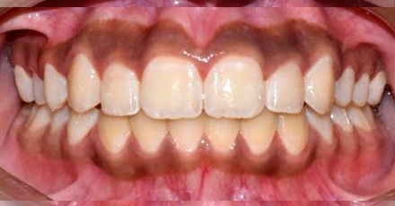 patient invisalign after[]