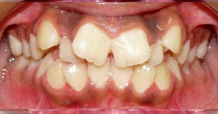 patient invisalign before[]