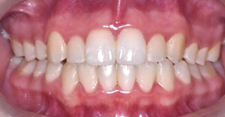 patient invisalign after[]