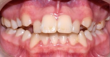 patient invisalign before[]