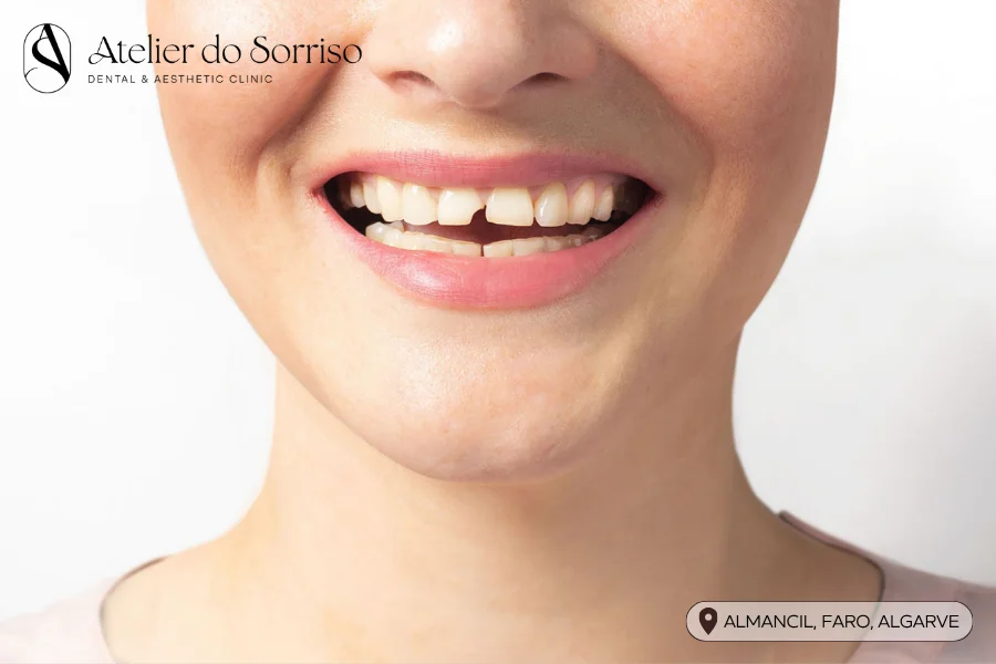 dente fraturado algarve faro almancil