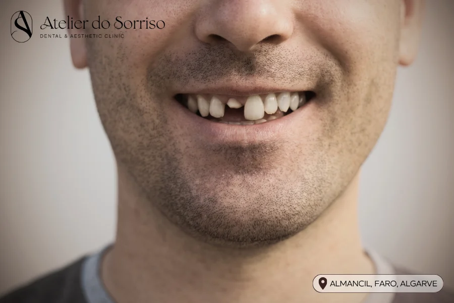 dente fraturado algarve faro almancil