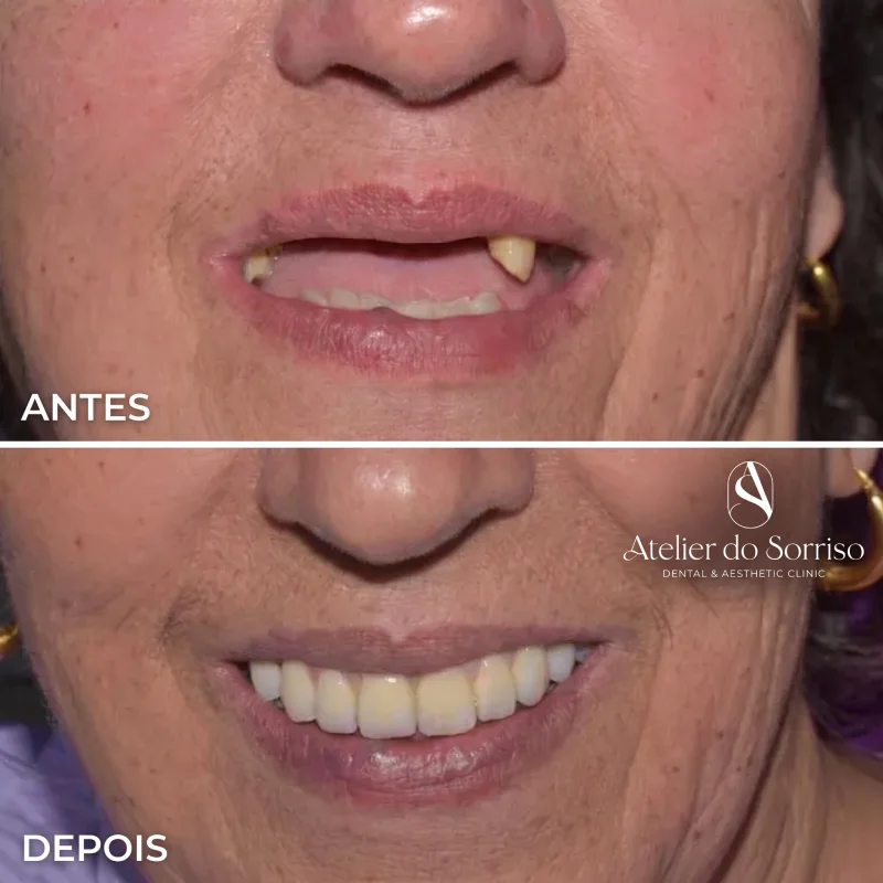 Transformação de Sorriso com All-on-4 no Atelier do Sorriso (Almancil, Algarve). Reabilitação oral total com dentes fixos sobre implantes, devolvendo a estética, a função mastigatória e a confiança para o seu dia a dia no coração do Algarve.