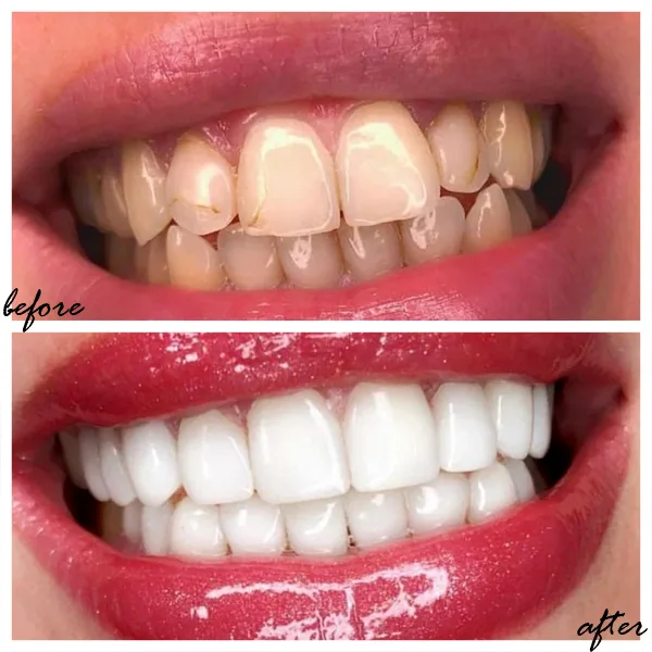 facetas dentarias antes depois algarve.webp