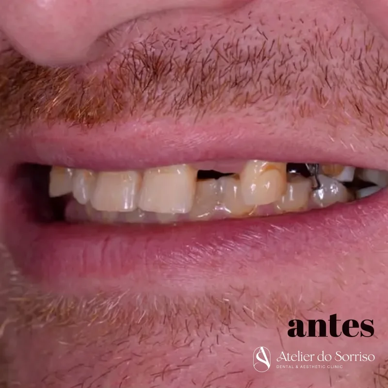 Imagem mostrando dentes ausentes, danificados ou próteses instáveis, ilustrando a necessidade de uma solução fixa e duradoura para recuperar o sorriso e a função mastigatória.