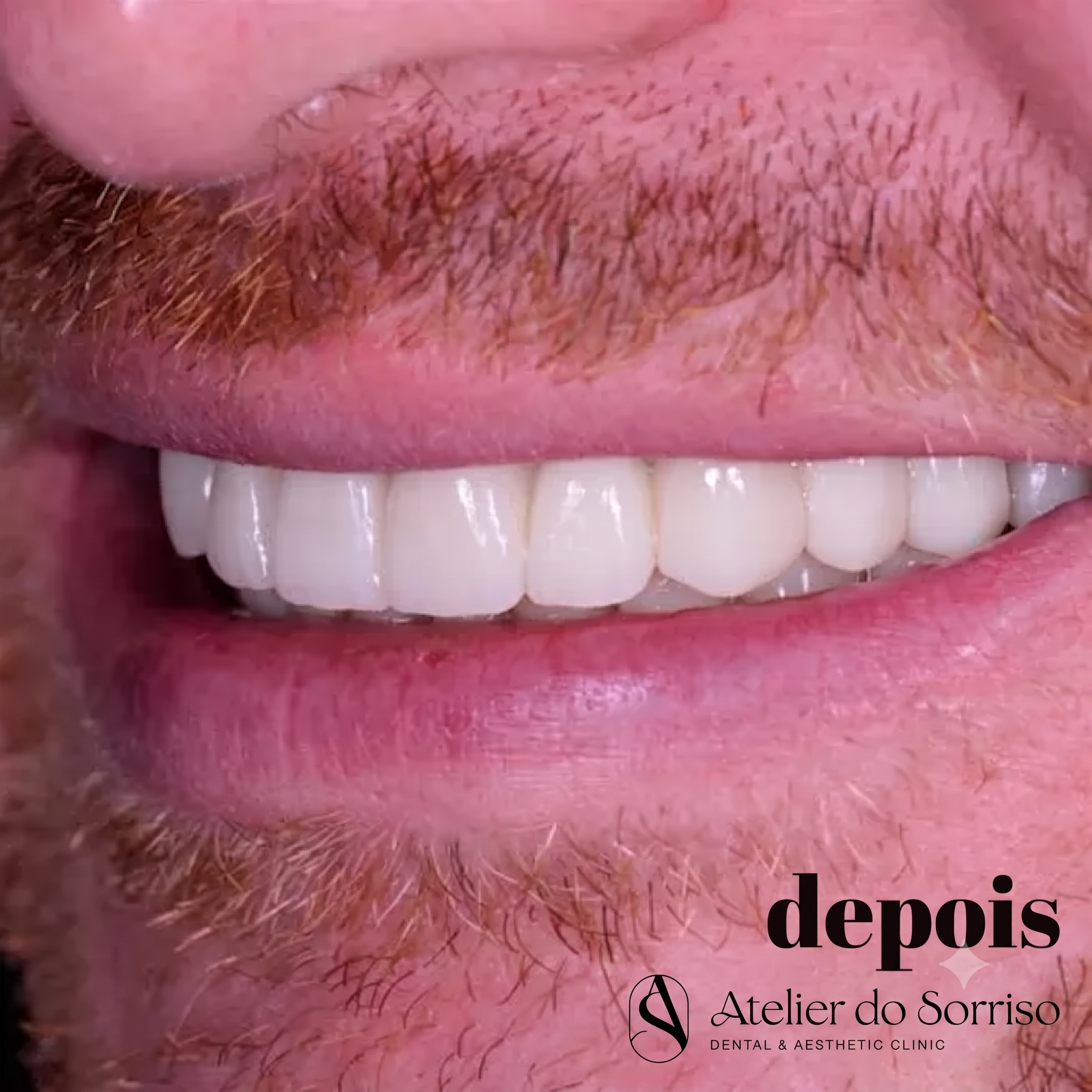 Imagem mostrando um sorriso completo, natural e fixo com a técnica All-on-4, devolvendo a estética, a função e a confiança do paciente em apenas um dia.