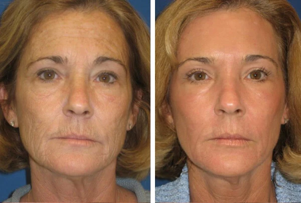 antes depois fotona d portugal[]